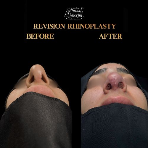 نتائج تجميل الأنف في الرياض 2025